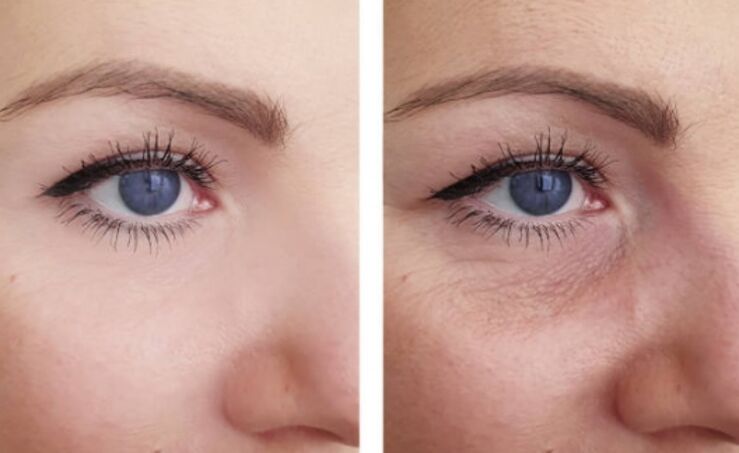 przed i po odmładzaniu osocza wokół oczu