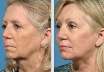 przed i po plazmowym odmładzaniu skóry