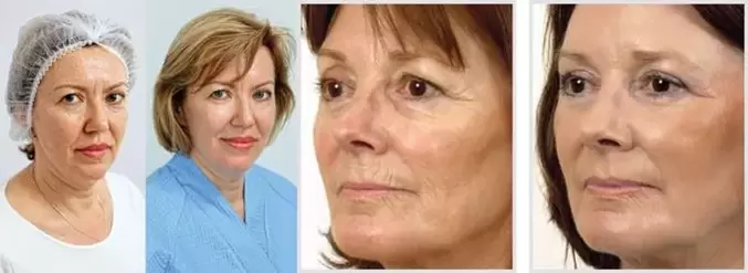 Efektem odmładzania skóry twarzy za pomocą lasera jest redukcja zmarszczek