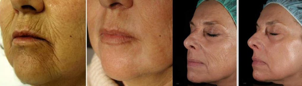 Skóra twarzy przed i po zabiegu laserowego odmładzania