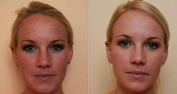 przed i po laserowym odmładzaniu skóry twarzy
