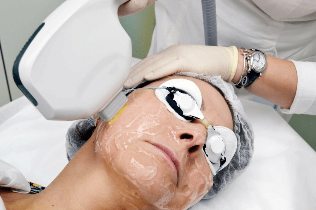 laserowe odmładzanie skóry twarzy
