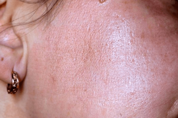 zaczerwienienie skóry po laserowym odmłodzeniu