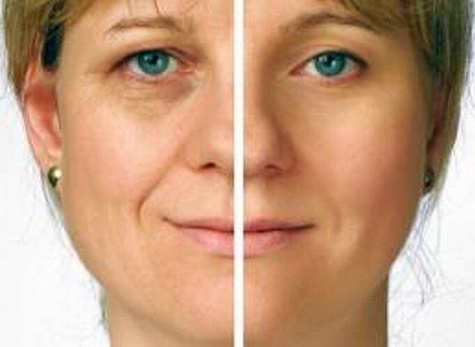 skóra wokół oczu przed i po odmłodzeniu