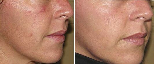 twarz przed i po sprzętowym odmładzaniu skóry